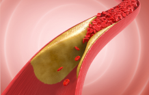 Projet NANOATHERO